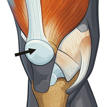 Tendonitis